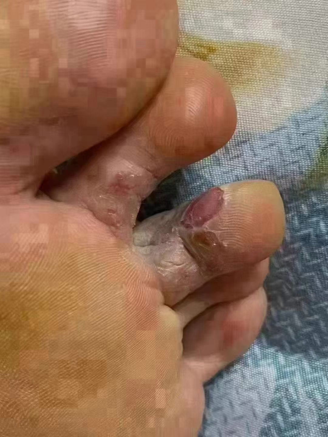 怎样有用减缓糜烂型脚气的瘙痒病症