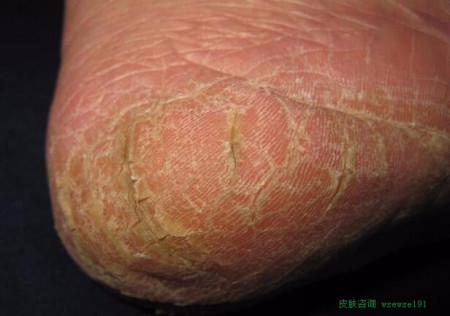 脱皮水泡脚气怎样医治