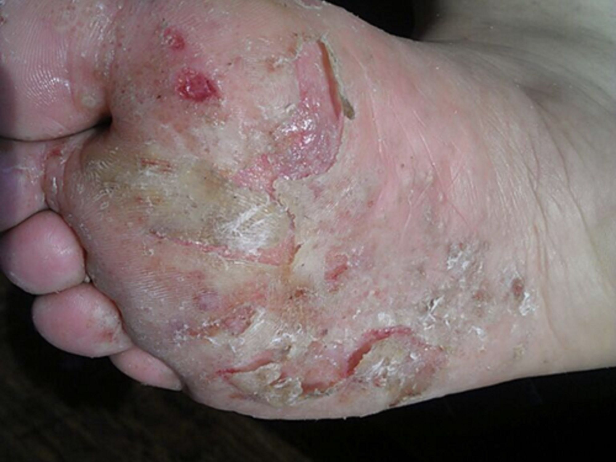 市情上有哪些除臭剂能够抑止脚臭