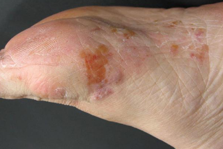 水疱型脚气怎样快速止痒