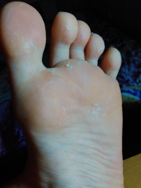 怎样去除脚气脚臭