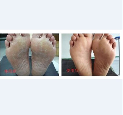 脚上有红斑一针见血呢