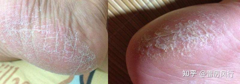 脱皮脚气怎样根治