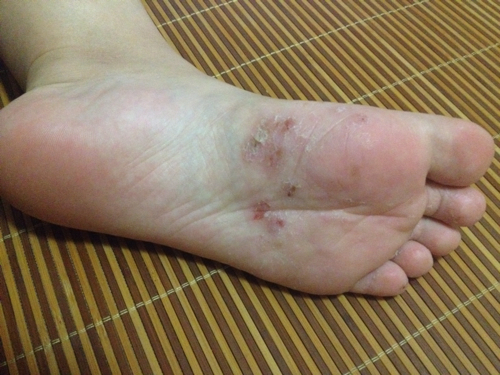 脚上起红斑一针见血