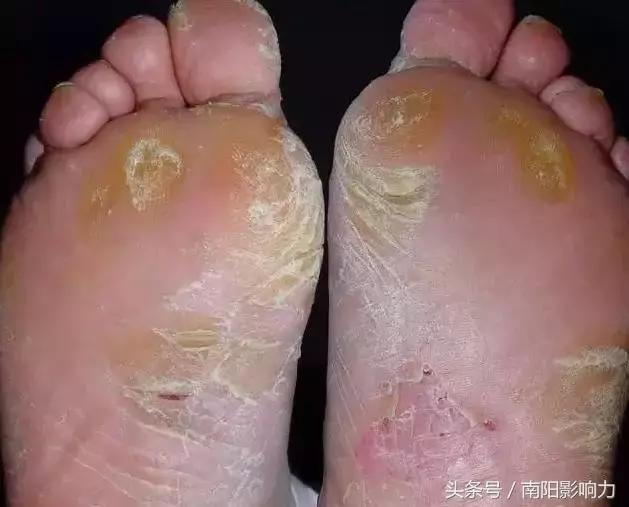 脚气褪皮严峻怎样医治