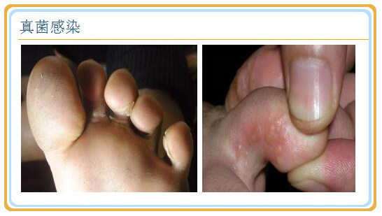 脚后跟起白皮是脚气吗