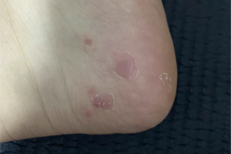 脚气长白色的黑点很痒怎样回事(图1) 脚气长白色的黑点很痒怎样回事