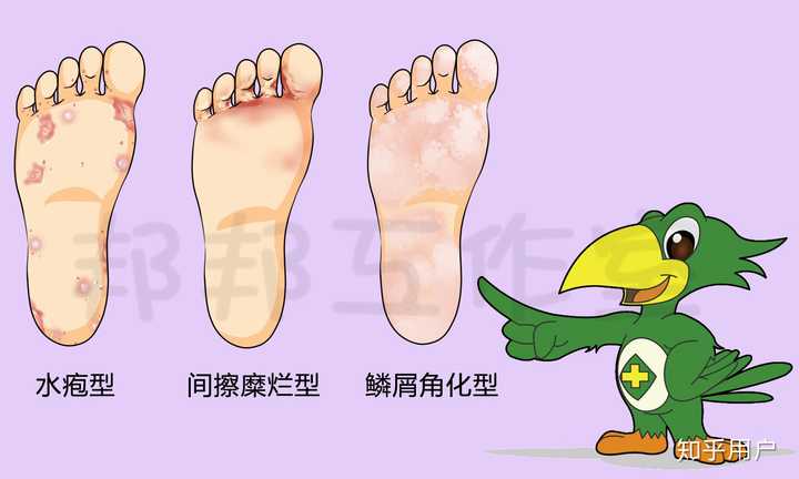 脚气的病因和发病机制(图1) 脚气的病因和发病机制