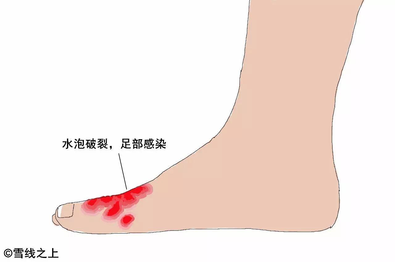 脚部水泡赤脚行走损伤