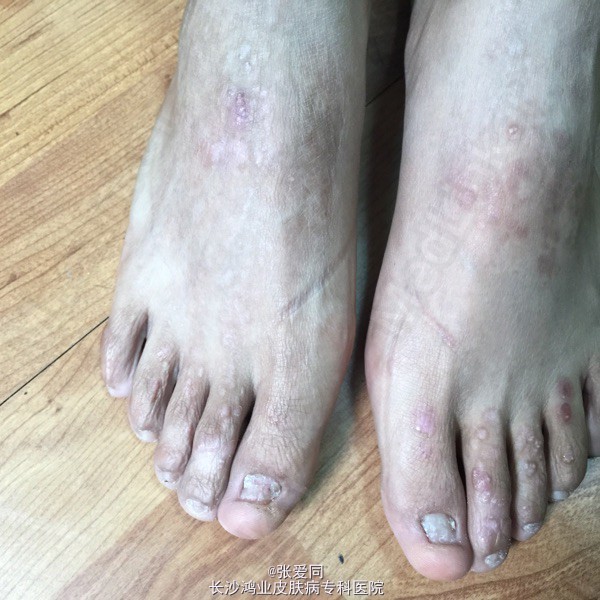 脚部水泡表皮松解成因
