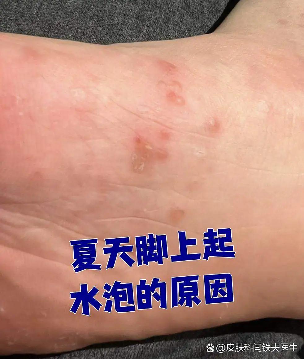 脚部水泡受力点反复起疱