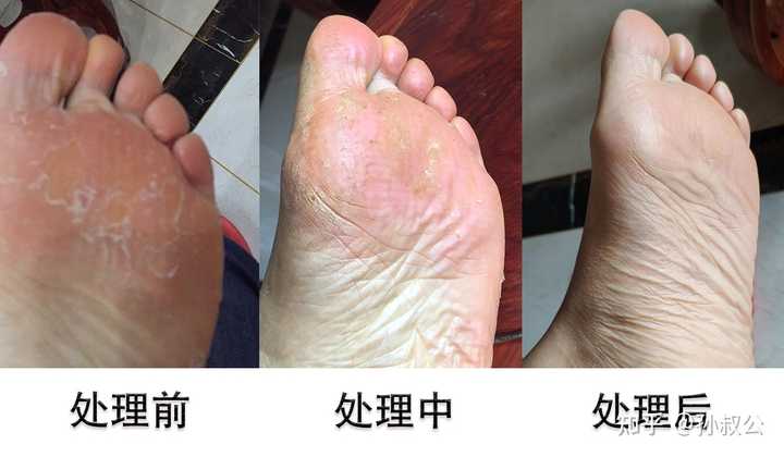 脱皮脚气后期修复要点