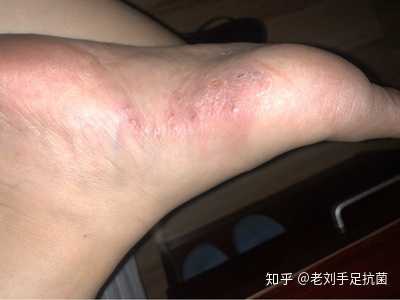 脚部水泡脚趾挤压起疱