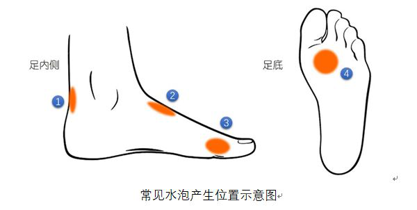 脚部水泡鞋带过紧压迫