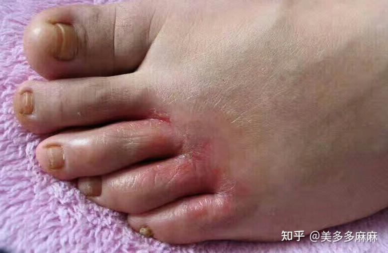 糜烂型脚气创面保护要点