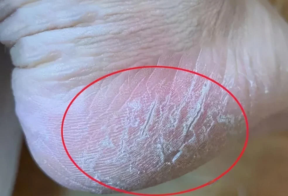 角化型脱皮脚部养护