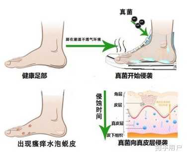 脚部水泡循环障碍诱因