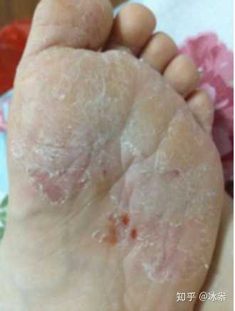 脚底起水泡是脚气吗