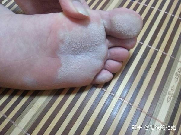 脚部白皮碎屑清理方法(图1) 脚部白皮碎屑清理方法