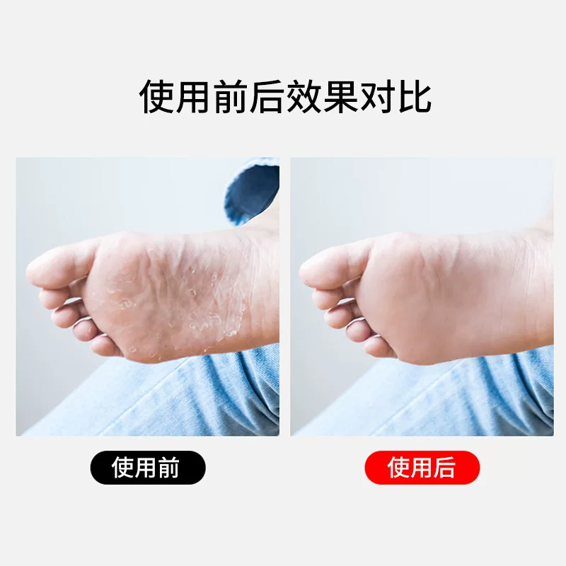 脚底厚重角质脱皮去除