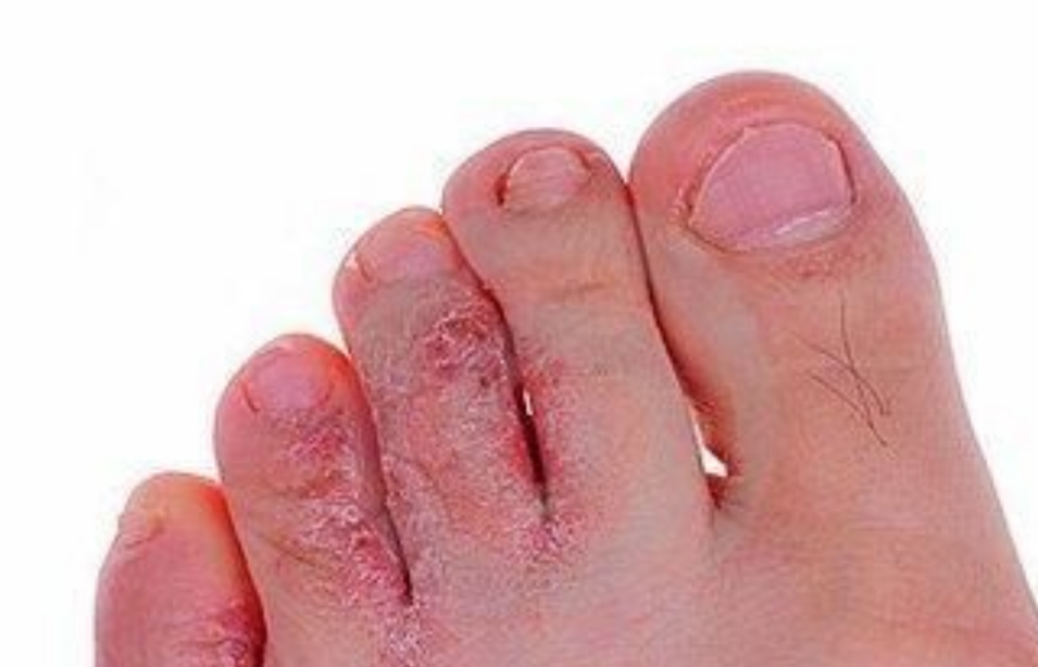 脚部水泡混合型肌肤炎症