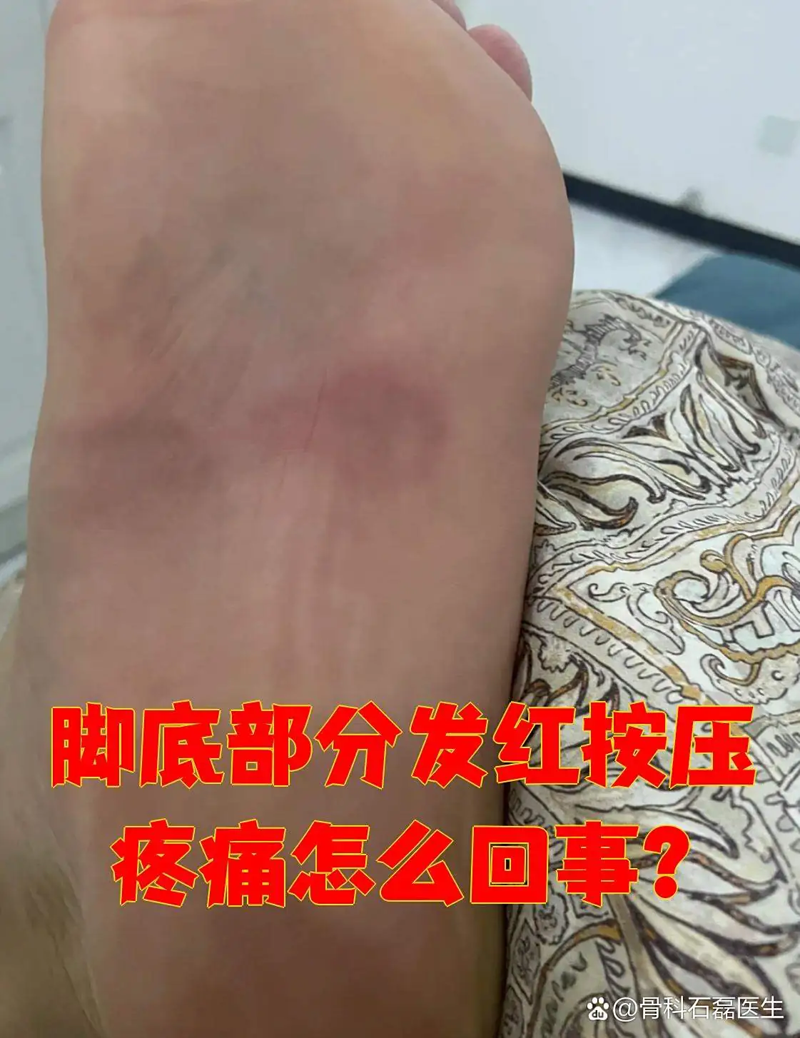 脚部红斑表层发红改善