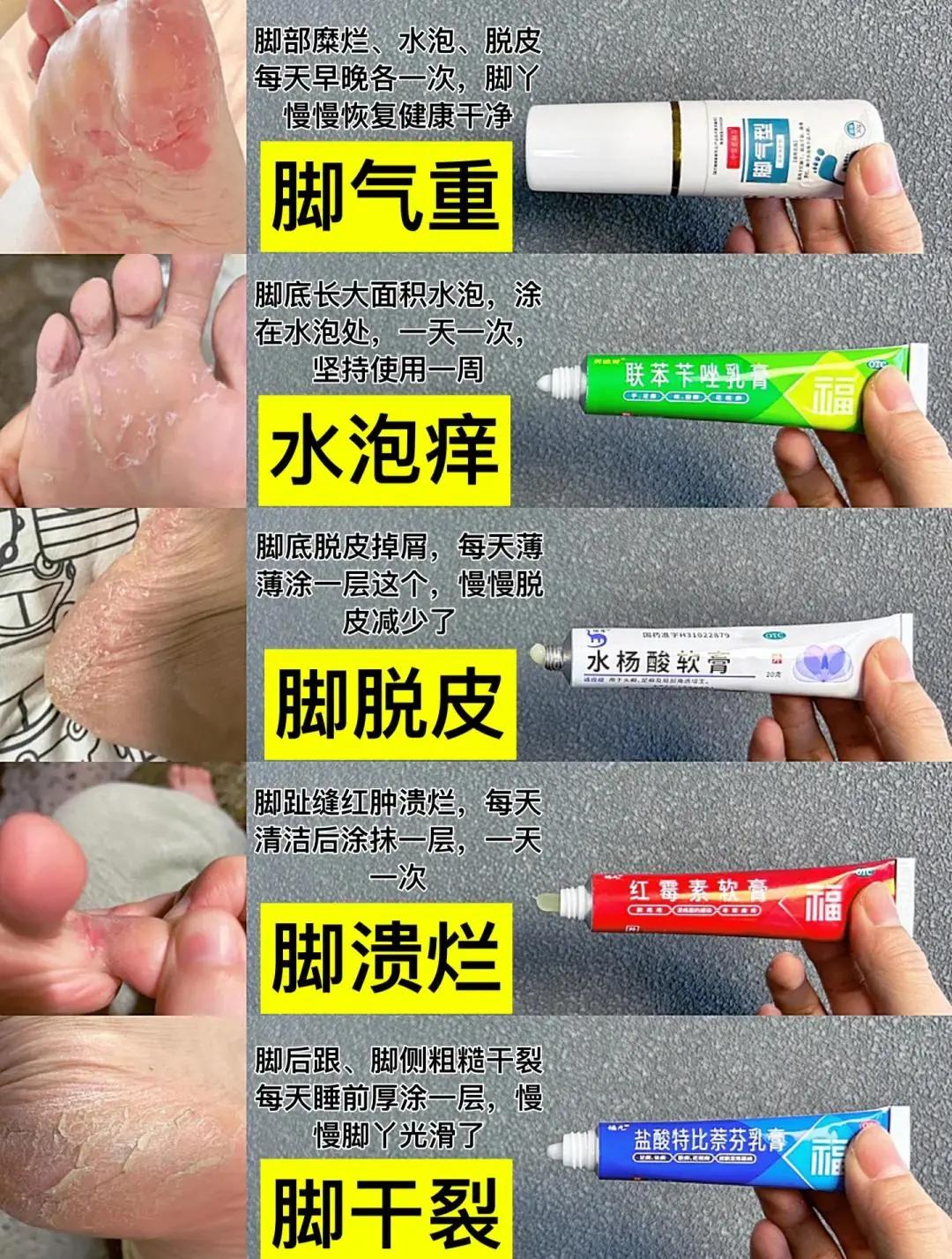 【临床研究】脚气复发的治疗新突破