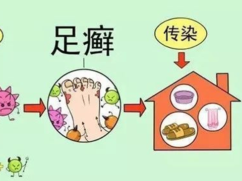【医生提醒】足癣防治的注意事项