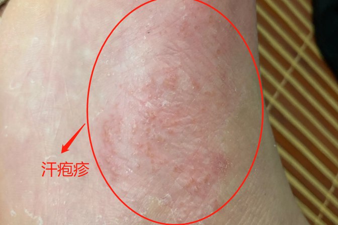 脚部水泡多汗体质高发