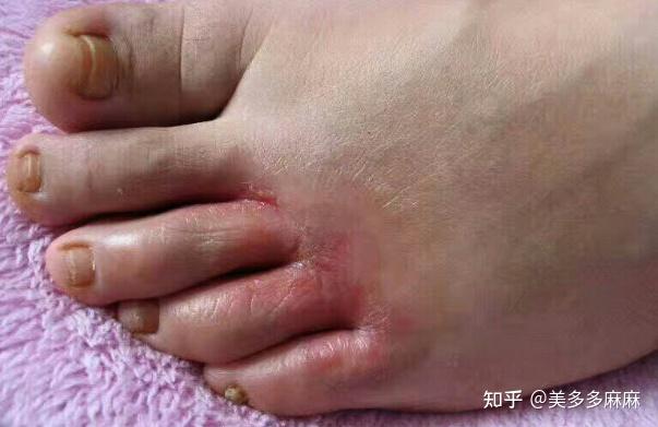 水泡型脚气预防常识