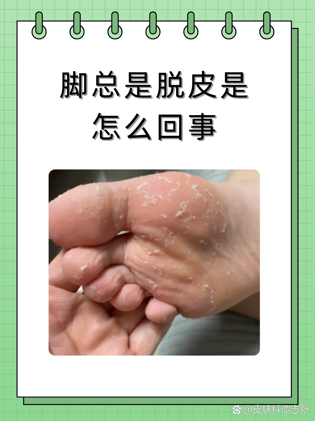 脚部脱皮反复不好