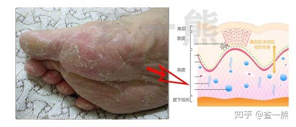 水泡型脚气角质定期打理