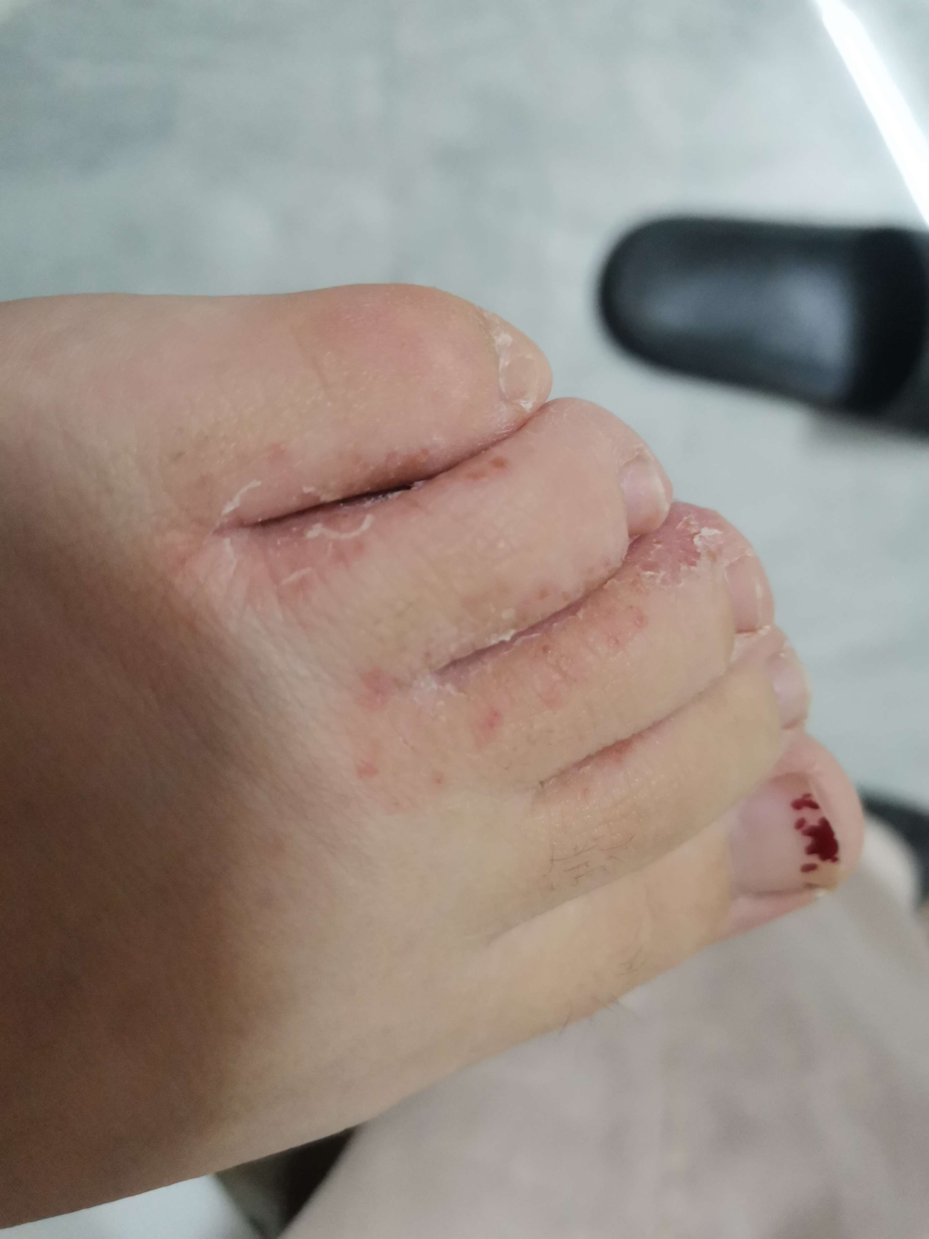 脚趾缝隙长期潮湿痒