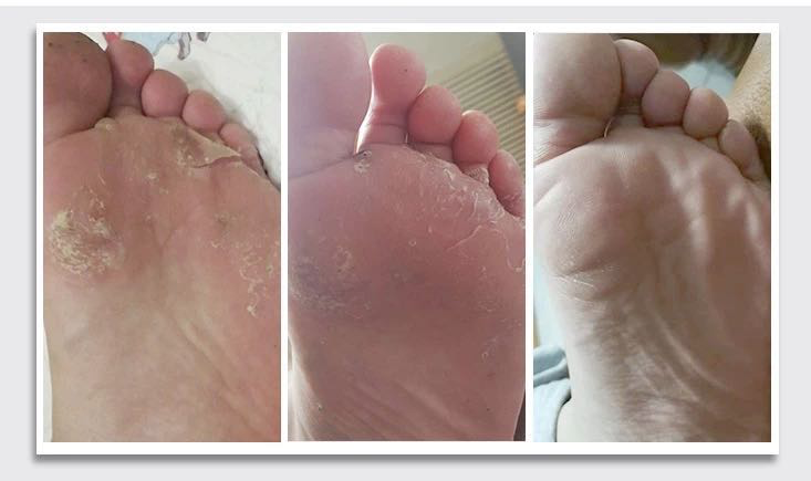 水泡型脚气运动前后防护