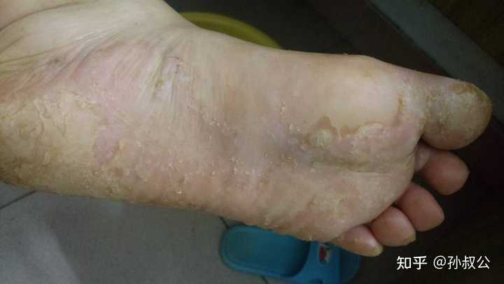 水泡型脚气户外出行预防