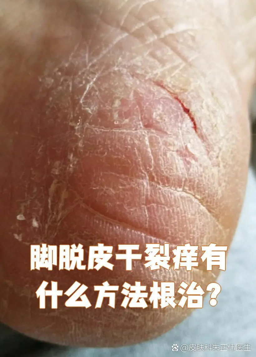 脚部脱皮伴随干痒