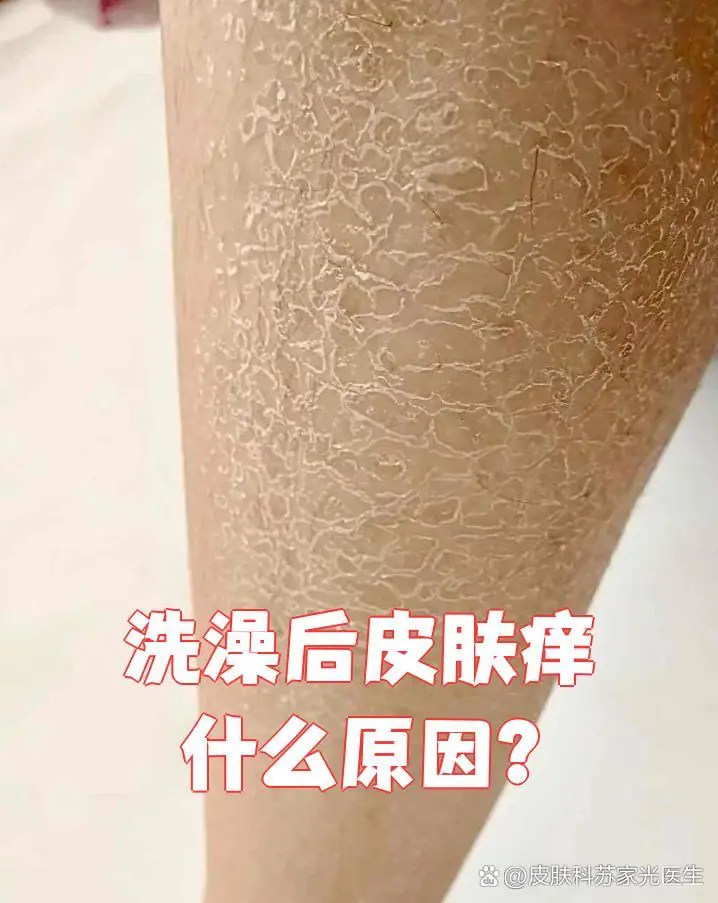 洗澡后脚痒诱发因素