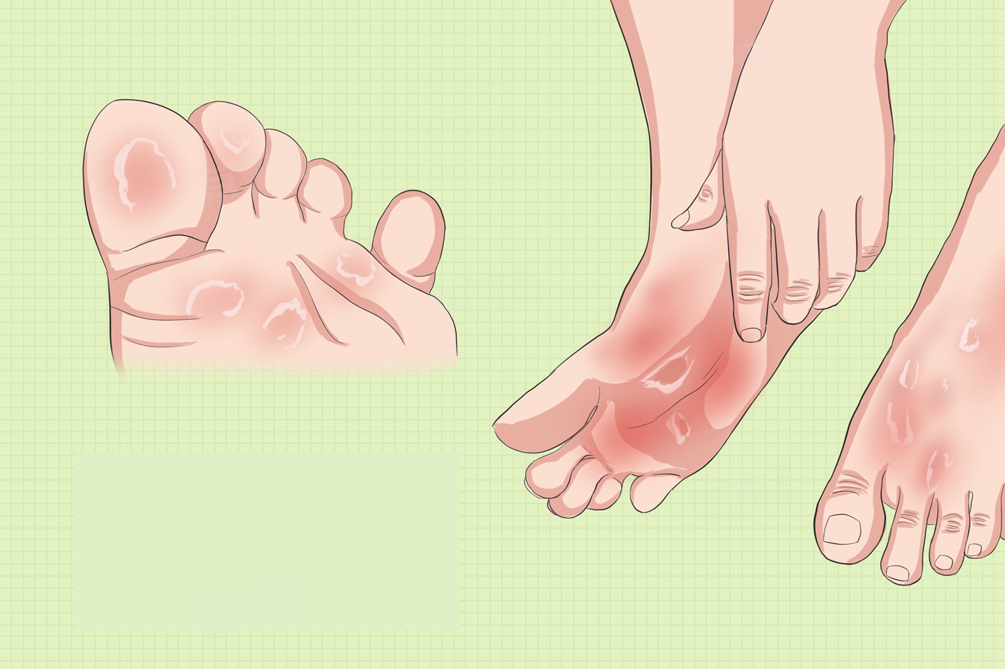 【临床研究】水疱型脚气的治疗新突破