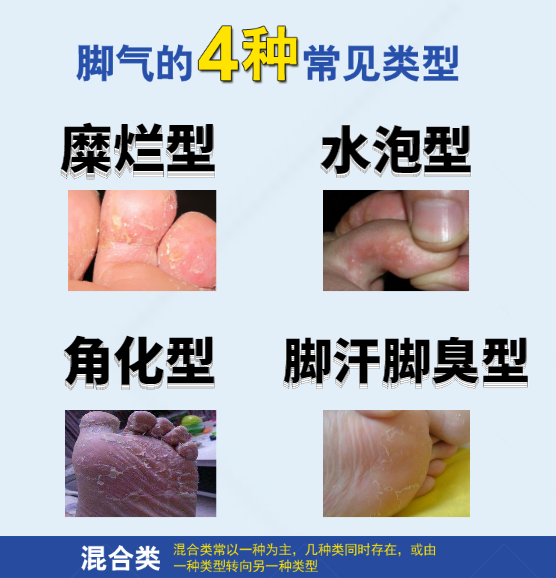 脚部透气性差危害