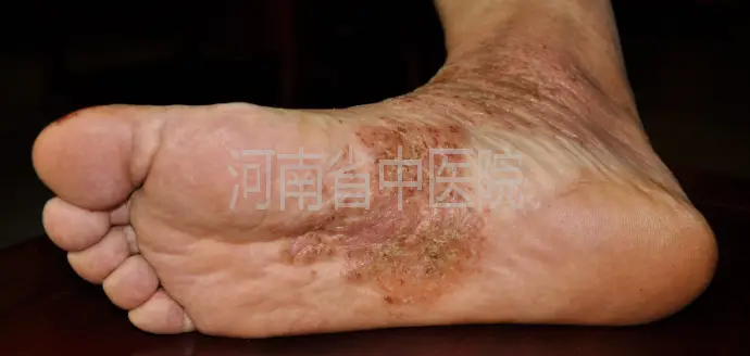 脚部红斑袜子过厚诱发