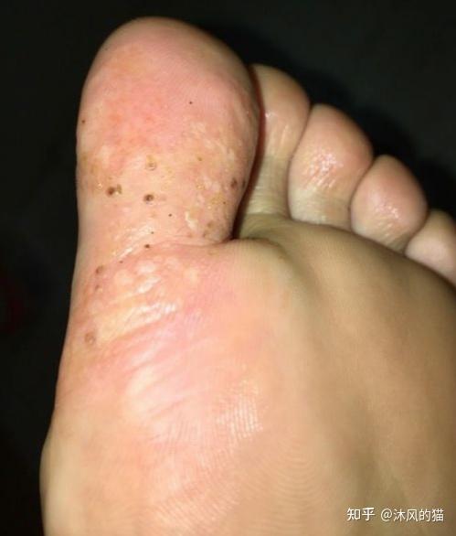 水泡型脚气胶鞋穿戴防护
