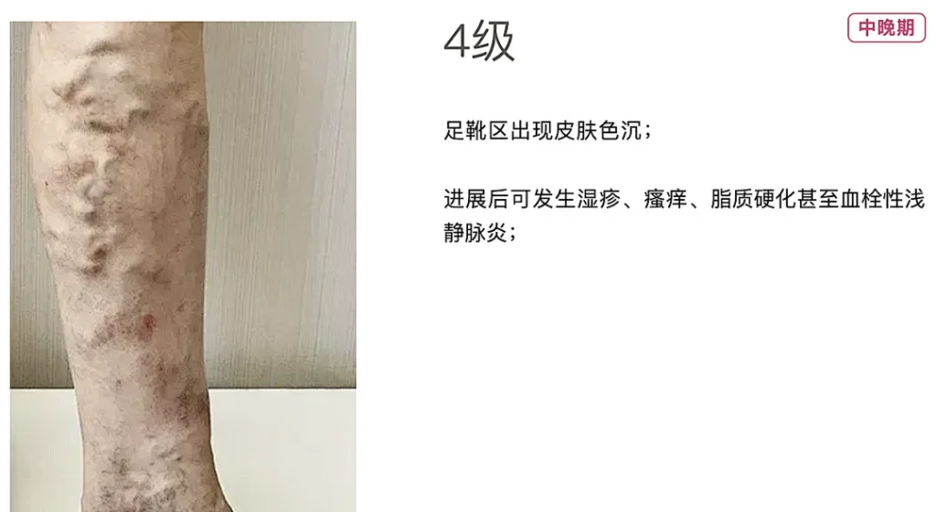 脚部红斑久站静脉回流差成因