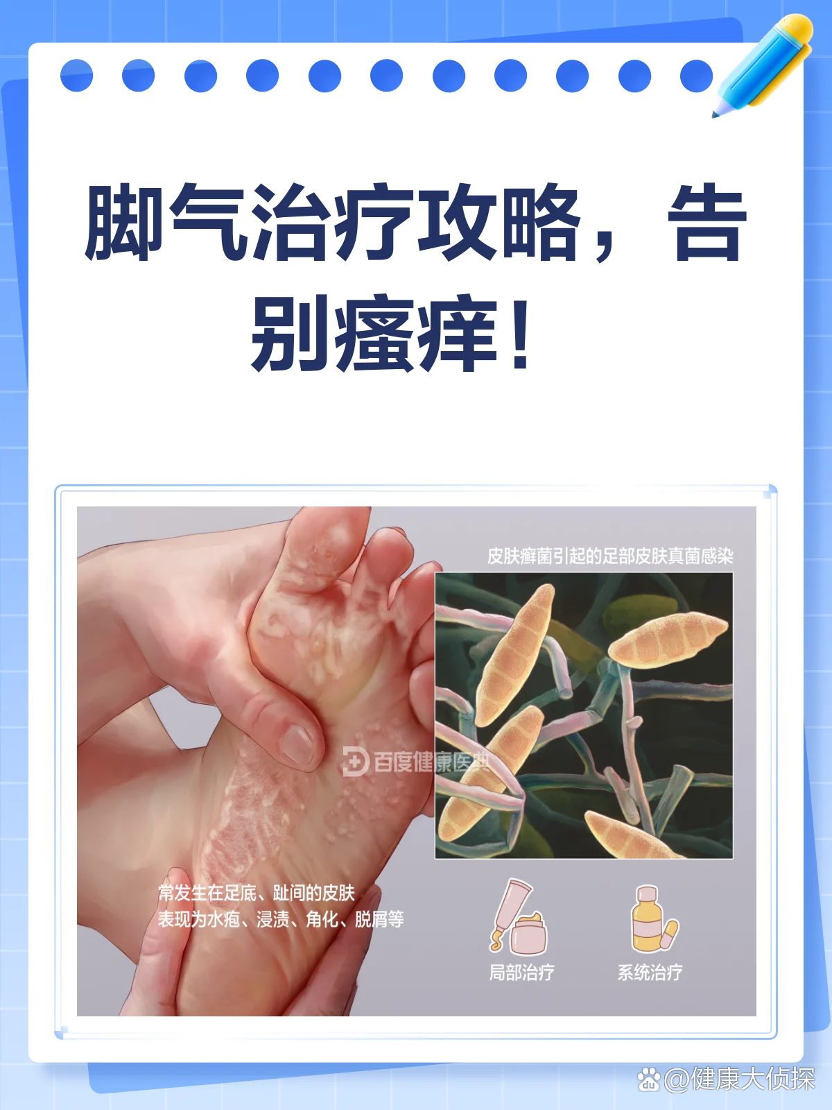 【专家解读】脚气复发的最新治疗方法(图1) 【专家解读】脚气复发的最新治疗方法
