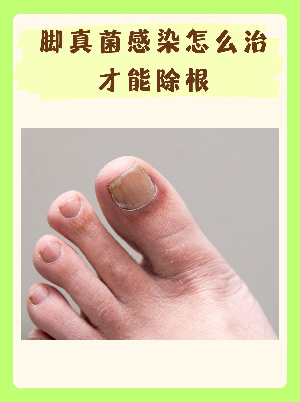 【病例分享】脚部真菌感染的成功治疗经验