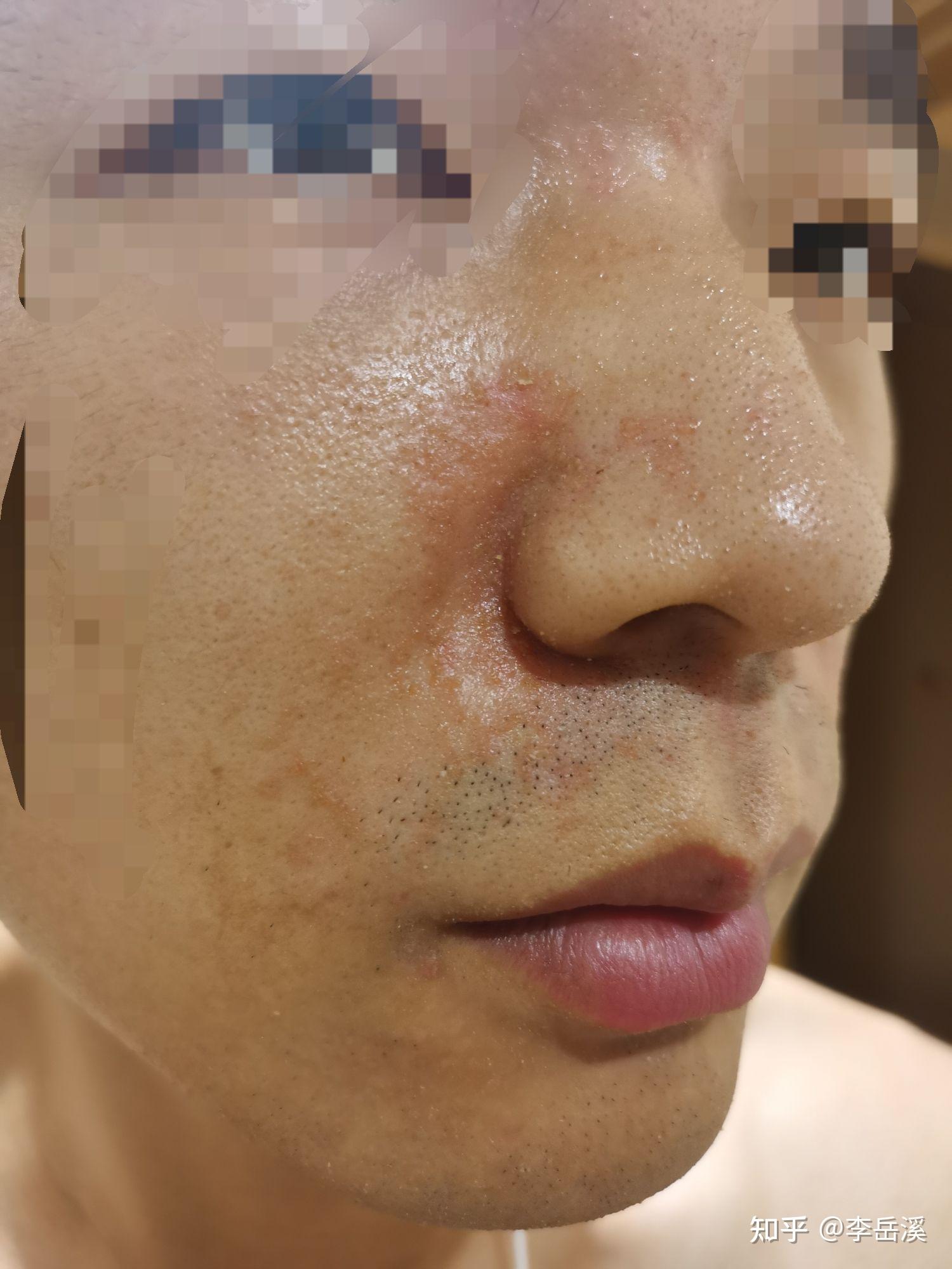 脚部红斑脂溢性皮炎诱发