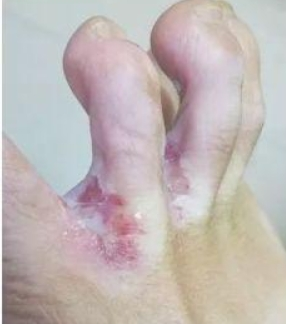 浸渍型糜烂快速恢复