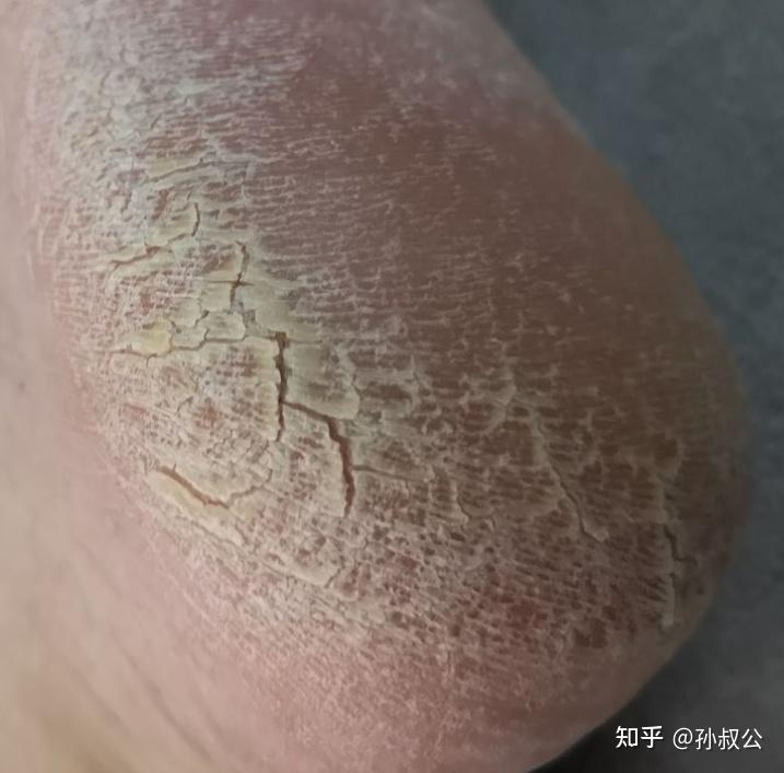脚部糜烂无刺激快速恢复