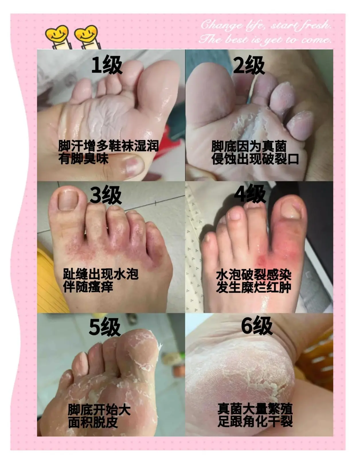 【健康科普】脚气预防患者必读指南(图1) 【健康科普】脚气预防患者必读指南