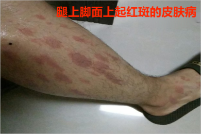 脚部红斑血液循环不畅诱发(图1) 脚部红斑血液循环不畅诱发