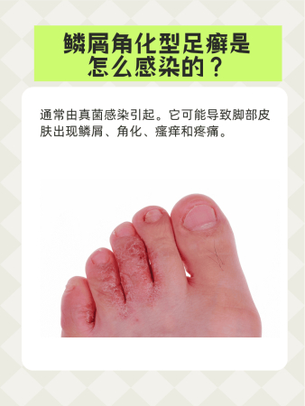 【专题报道】足癣防治的综合治疗方案(图1) 【专题报道】足癣防治的综合治疗方案